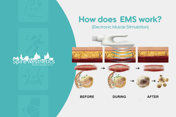 EMS treatment for post pregnancy weight loss treatment West End