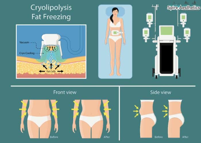 Image of diet and fat freezing combined for best results for Spire Aesthetics West End
