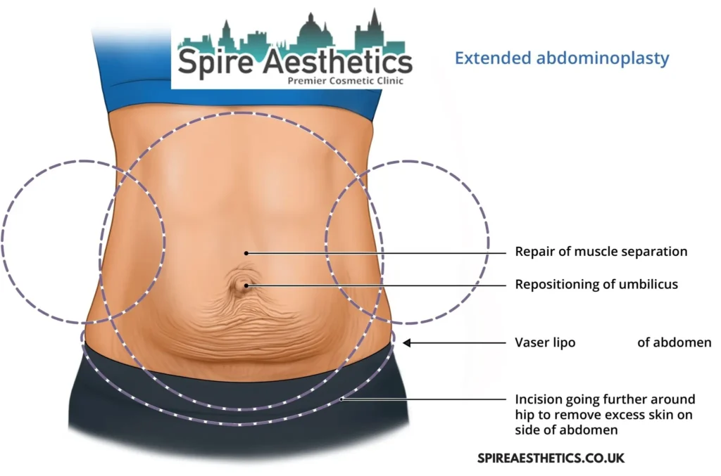 Understanding Loose Skin After Gastric Band West End Surgery and HIFU Treatment