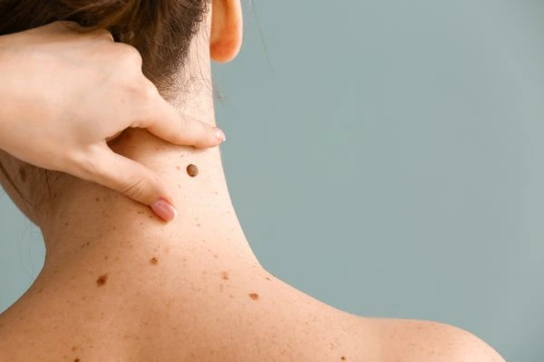 skin blemish removal West End treatment