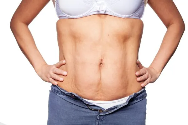 sagging skin on woman's stomach after weight loss injections West End