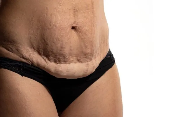 Image of womans stomach after weight loss injections West End showing saggy skin